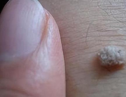 手臂一捏肉里都是颗粒