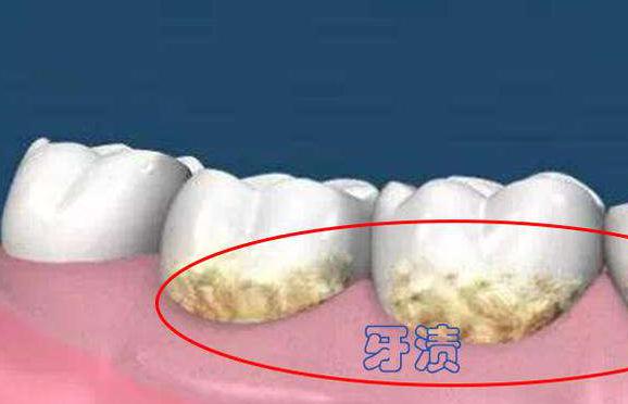 牙齿喝茶容易有颜色怎么办